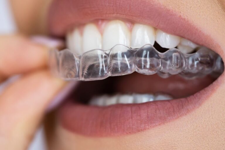 Invisalign near you