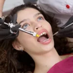 bonded fillings vs traditional fillings